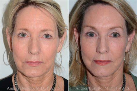Brow Lift Miami - Lift Your Look with Dr. Bustillo