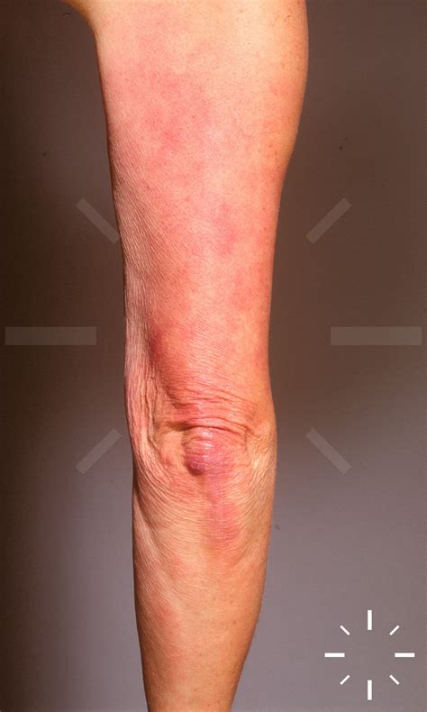 DermaCompass - Acrodermatitis chronica atrophicans