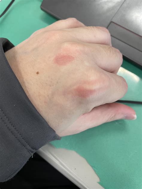 Is this AS related? I’ve randomly been getting red marks around my knuckles. Granted, lately my ...