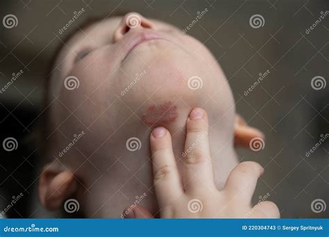 Circular Rash On My Chin