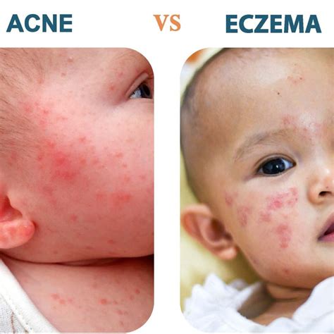 Eczema Face Baby Baby Care, Sensitive Skin Products, And Eczema