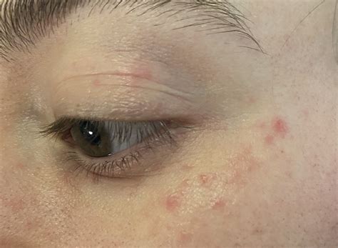 OTC treatment for small red bumps around eyes? : DermatologyQuestions