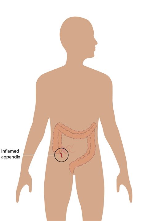 Where Are Your Appendix Located Vermiform Appendix – Anatomy QA
