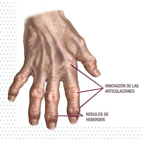 Enfermedad de Mano - Artrosis en las manos