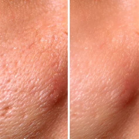 Laser Skin Resurfacing Pores