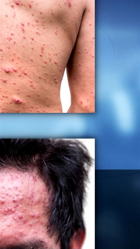 Herpes Gladiatorum Wrestling