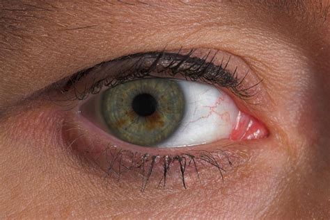 What Is An Eye Stroke