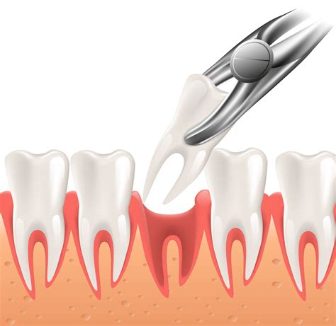 Tooth Extraction Home Care Instructions | Cobblestone Dental Care