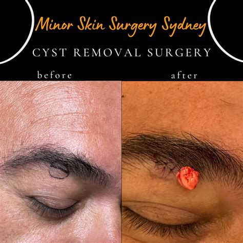 Cyst Surgery, Cyst Removal, Cyst Treatment Sydney