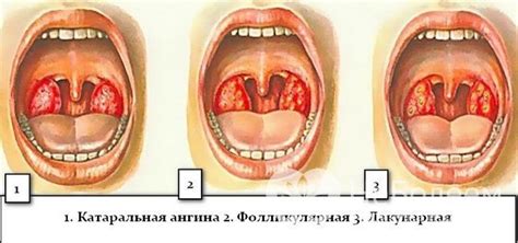 Гнойная ангина – симптомы, лечение, причины, осложнения, признаки