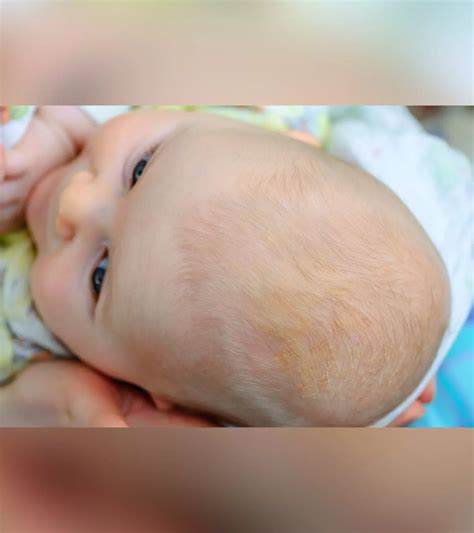 Sacral Dimples in Newborn: Symptoms, Causes And Treatment