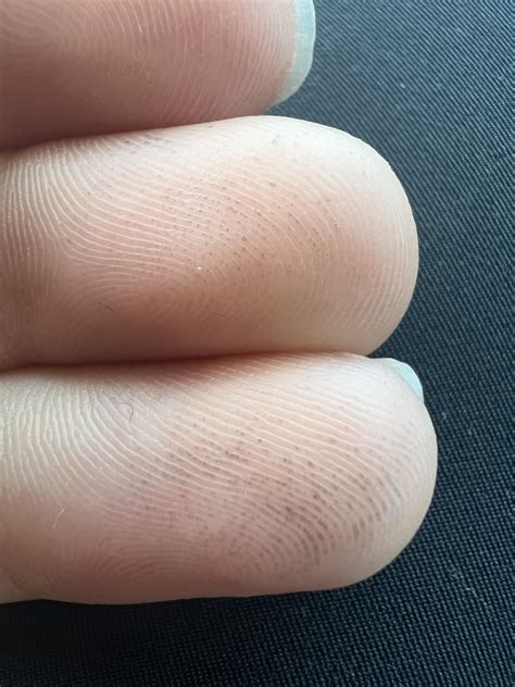 Black dots on fingertips : r/DiagnoseMe