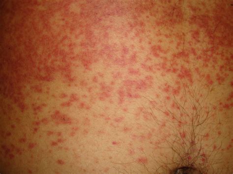 Urine Infection And Rash On Stomach at Richard Weaver blog