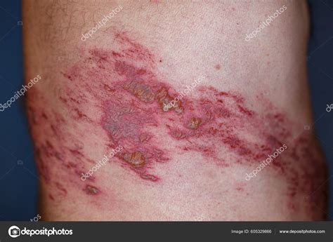 Skin Lesion Symptom Shingles Herpes Zoster Human Shingles Herpes Zoster stok fotoğrafçılık ...
