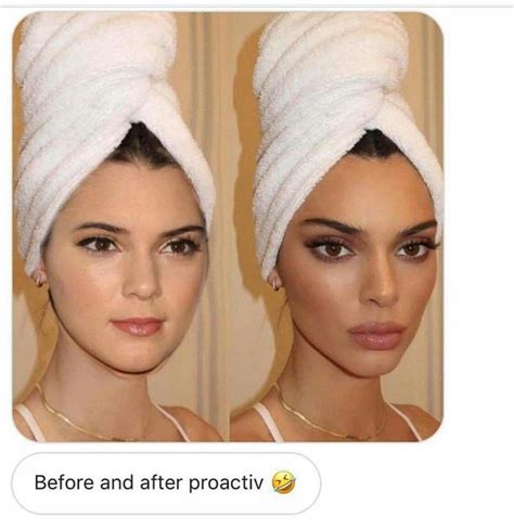 Pin by Misty James on Lol | Facial fillers, Celebrity plastic surgery, Rhinoplasty nose jobs