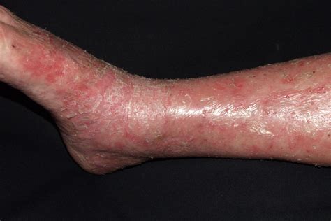 Tema 09. DERMATITIS ATÓPICA Y OTROS ECZEMAS - Dermatopharm