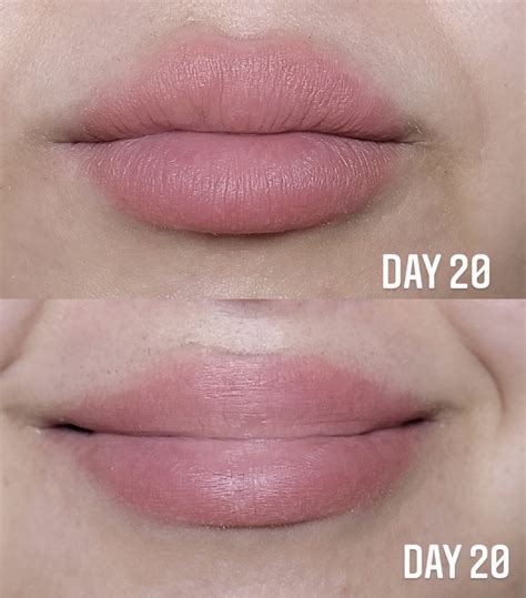 Fordyce Spots Lips Treatment Before And After - Infoupdate.org