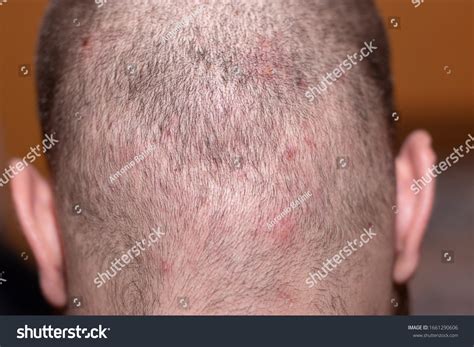 Pimple Looking Bumps On Head