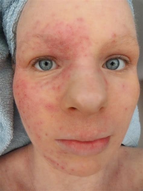 Eczema Herpeticum Pictures at Wesley Simmons blog