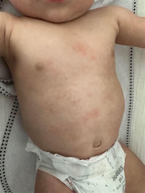Rash? Eczema? Milk allergy?? : r/newborns
