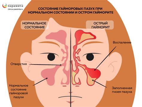 Все о лечении гайморита: причины, симптомы, диагностика