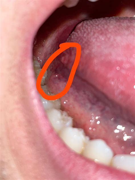 What is this bump on the side of my tongue? It isn’t painful but i notice it when i move my ...