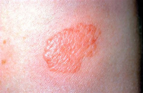 Tuberculosis Test: Methods, Results, Risks, and More