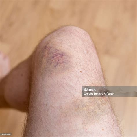 Huge Bruises On The Mans Leg On The Knee Closeup Of A Bruised Leg With A Hematoma Stock Photo ...