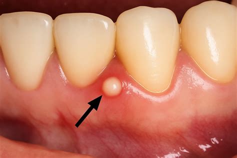 Dental Abscess: Full Guide with Images & Treatments
