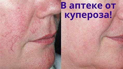 От купероза и сосудистой сеточки! Домашняя косметика от купероза своими ...