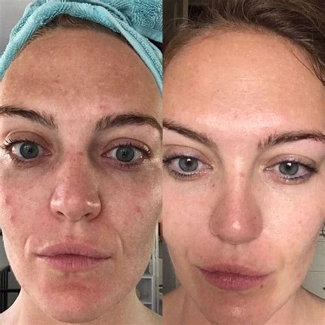 Microneedling Before and After Wrinkles - See the Difference!