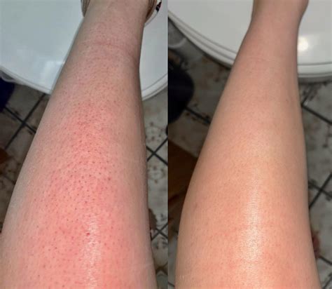 Laser Hair Removal Results Legs