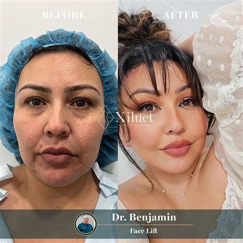 Top-Rated Face Lift Surgery | 10+ Years Experience