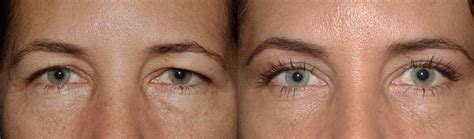 Endoscopic Brow Lift Results at Penny Troche blog