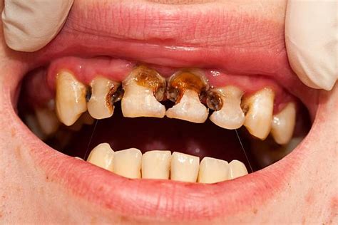 Can bad teeth cause health problems?