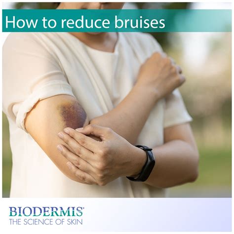 How To Reduce Bruising