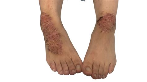 Dermatitis De Contacto Irritativa De La Sociedad