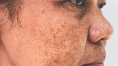 Hyperpigmentation Face