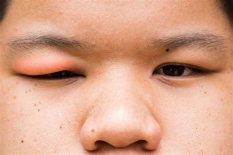 Swollen Eyelids: Treatment and Remedies