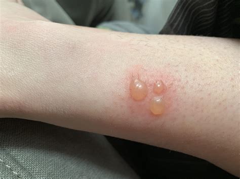 Blister Bug Bite