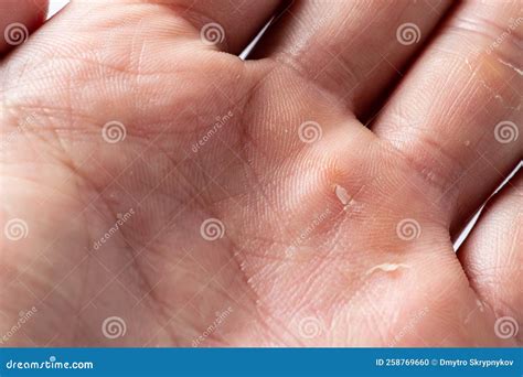 Hand Callus Pictures at Frank Keith blog