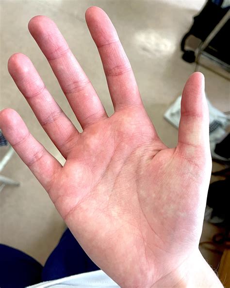 white spots all over palms : r/Hyperhidrosis