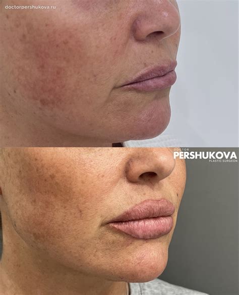 Пластика губ Кессельринг в Москве - цены в Damas Clinic | Стоимость ...