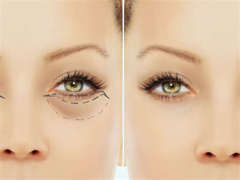 Blepharoplasty (Eyelid Surgery): What it is and post-op treatment