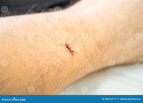 How to Know When You Need Stitches: A Clear Guide | nphcda.gov.ng