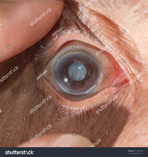Close Senile Cataract During Eye Examination Stock Photo 173507780 | Shutterstock