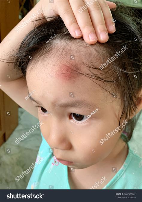 Pimple Looking Bumps On Head