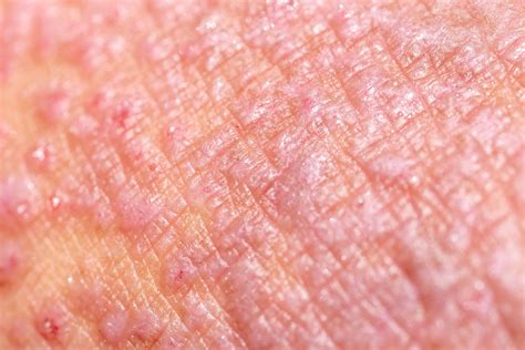 Heat Rash vs Eczema: Symptoms, Causes, Treatment
