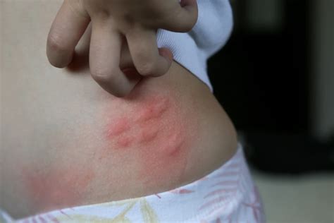 Spider Bite vs. Mosquito Bite: Identifying the Culprit - Hiriart ...