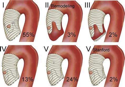 German Aortic Root Repair Registry—Insights From the First 400 Consecutive Patients - The Annals ...